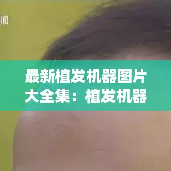 最新植发机器图片大全集：植发机器哪里有卖 