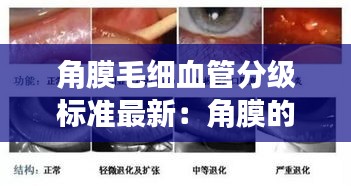 角膜毛细血管分级标准最新：角膜的血管 