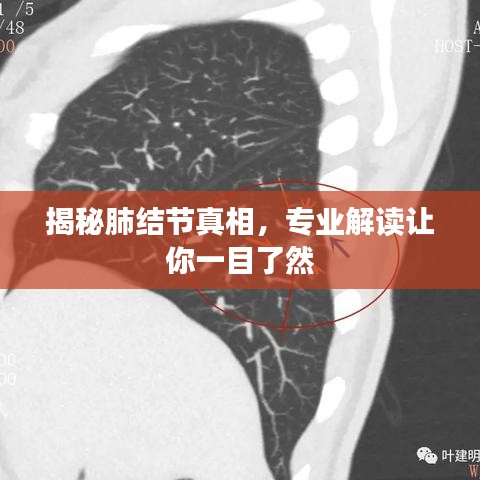 揭秘肺结节真相，专业解读让你一目了然